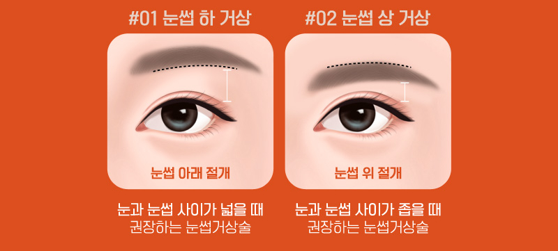 Differences Between Upper Eyelid Lift and Upper Blepharoplasty, and Brow Lift Scars: Explained by a Board-Certified Plastic Surgeon image 8