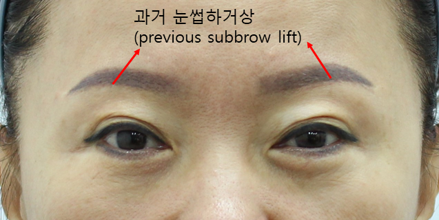 눈썹하거상술 후 상안검과 눈매교정 관련 이미지 1