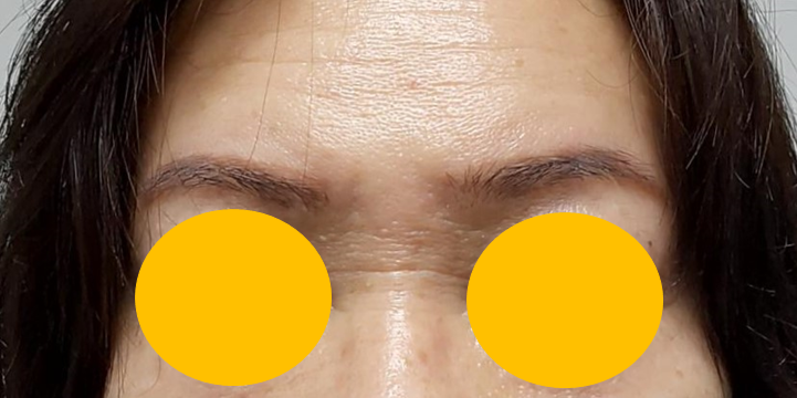 콧등 가로주름과 이마거상에서 중요한 고정포인트 관련 이미지 1