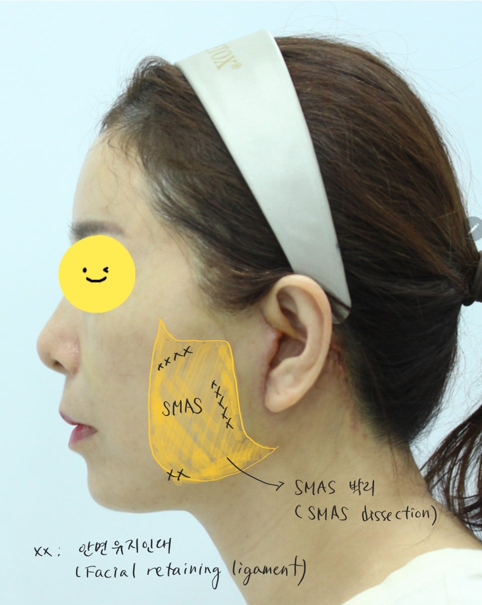 안면거상의 회복기간 관련 이미지 4