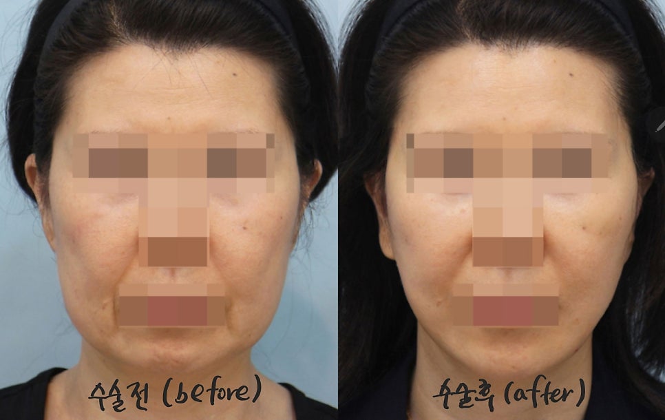 Dissection Range in Facelift Surgery image 5