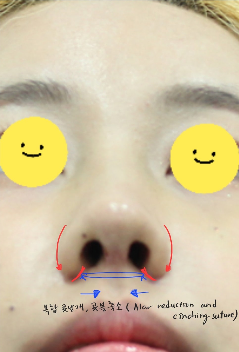 Two Methods of Nostril Reduction (Alar Reduction) image 4