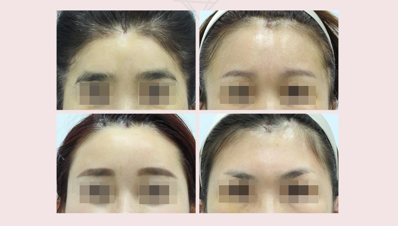 【Garnet Plastic Surgery Dr. Baek Insoo’s Plastic Surgery Column】 Fast Recovery After Pentafix Forehead Lift image 7