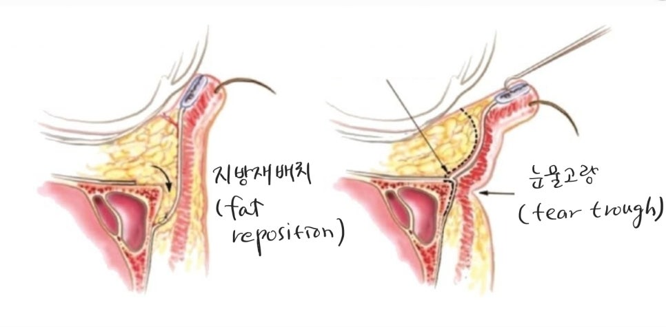 Under-Eye Fat Repositioning and Aegyo-Sal Fat Grafting image 4