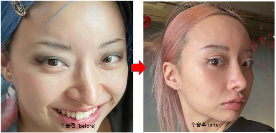 Rhinoplasty for Zainichi Koreans, Rhinoplasty for Japanese Koreans image 7
