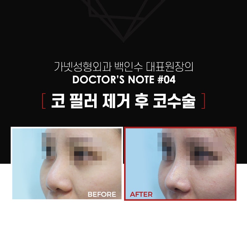 【가넷성형외과 백인수원장 성형칼럼】 코필러제거 후 코수술 케이스 관련 이미지 2