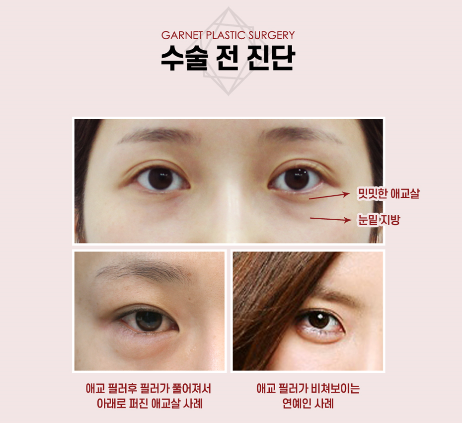 【가넷성형외과 백인수원장 성형칼럼】 애교필러 VS 눈밑 미세지방이식 관련 이미지 3