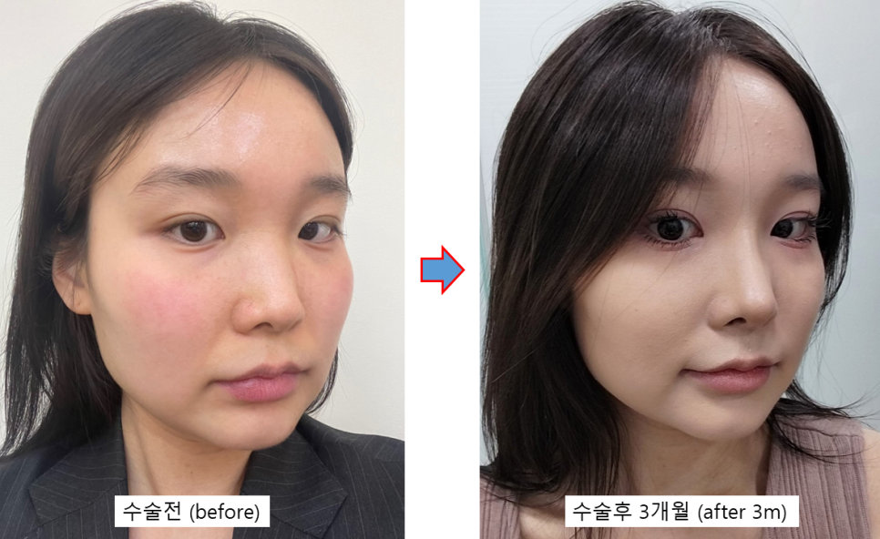 Will Rhinoplasty Cause Inflammation If You Have It in the Summer? Here’s a Real Recovery Case image 5