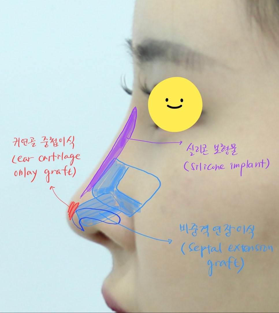 코성형에서 비중격 연골과 귀연골의 용도 관련 이미지 10