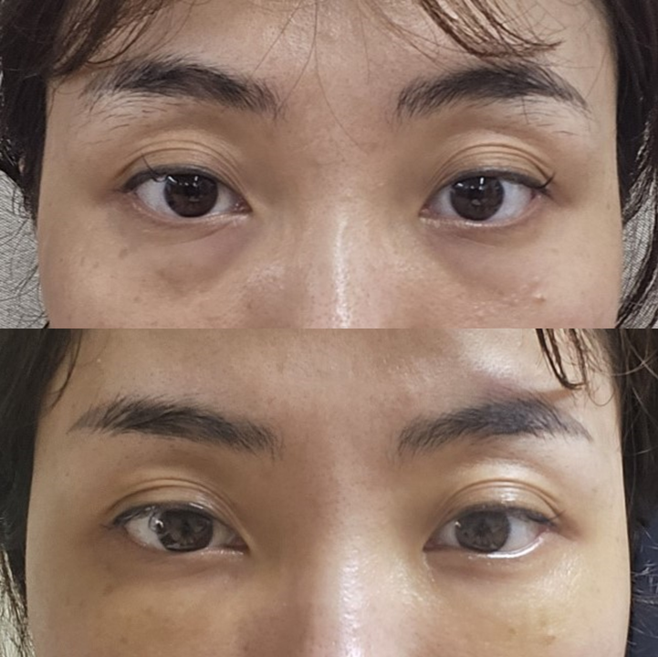 여름휴가 성형, 직장인에게 인기 있는 눈밑지방재배치(Hamra법) 관련 이미지 5