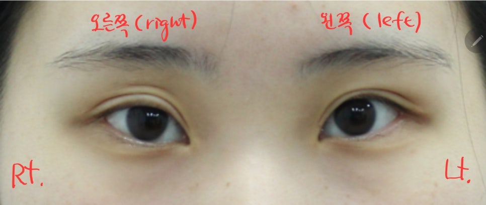 안검하수가 동반된 짝눈의 쌍꺼풀 재수술 관련 이미지 2