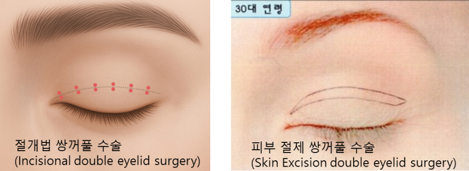 Why Forehead Lift and Double Eyelid Surgery Are Performed Together in Younger People image 1