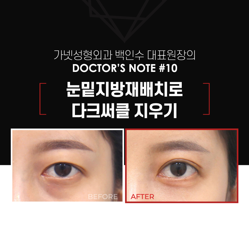 【Garnet Plastic Surgery Director Baek In-su’s Plastic Surgery Column】 Erasing Dark Circles with Under-Eye Fat Repositioning image 2