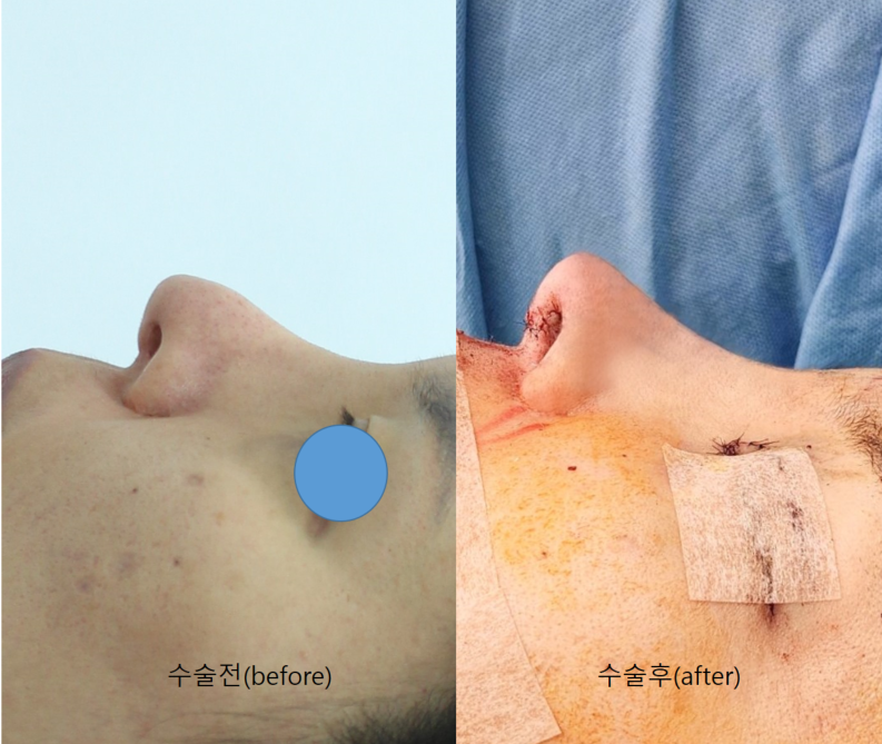 Rib Cartilage Nose Revision Surgery for Bird Beak Deformity image 8