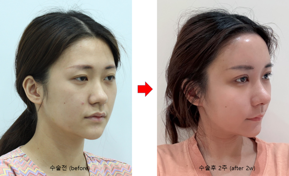 20~30대 종합성형 수술순서와 회복기간 관련 이미지 4