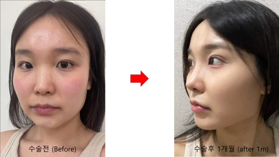 Precautions When Using Ear Cartilage in Rhinoplasty image 5