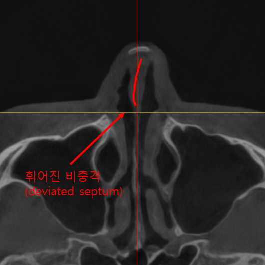 고어텍스 보형물을 자가조직으로 교체하는 코성형 관련 이미지 3