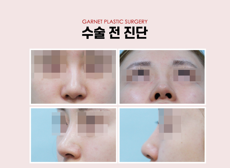 【가넷성형외과 백인수원장 성형칼럼】 휜코 무보형물 코성형 시 주의사항 관련 이미지 3