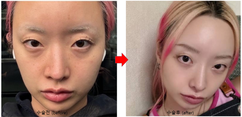 Rhinoplasty for Zainichi Koreans, Rhinoplasty for Japanese Koreans image 8