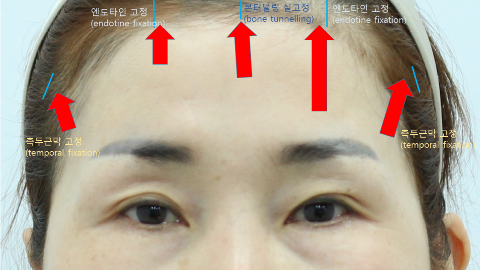 The Effect of Forehead Lift Surgery on the Eyes image 4