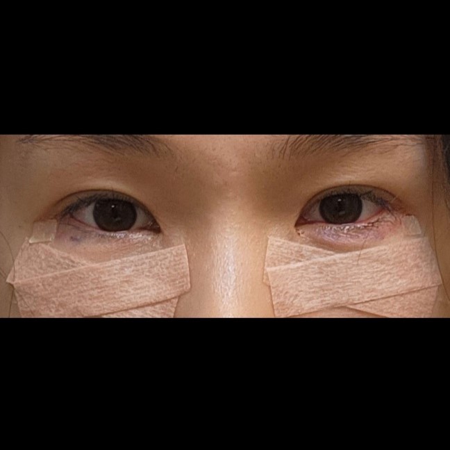 Under-Eye Fat Repositioning and Aegyo-Sal Fat Grafting image 8
