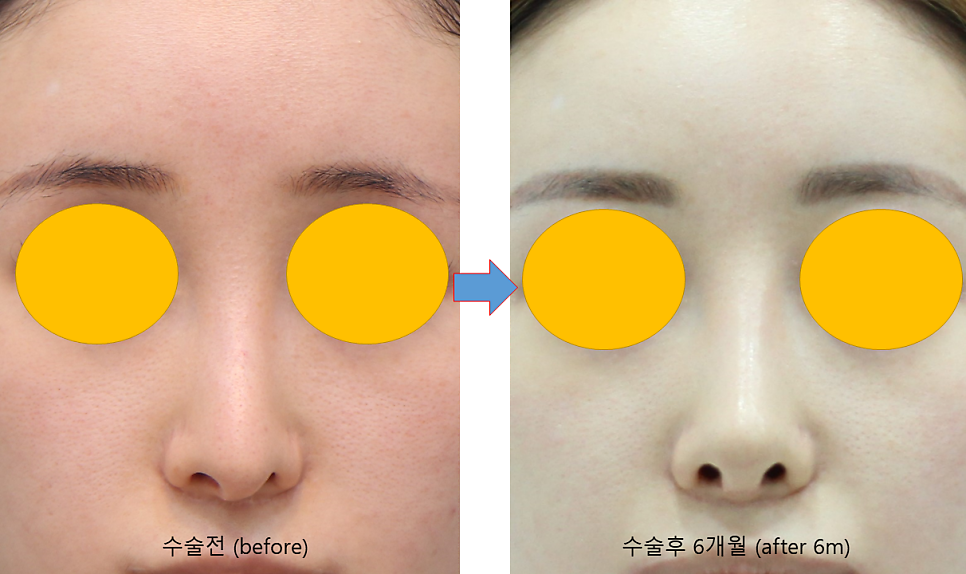 Consultation Process and Surgical Items for Revision Rhinoplasty image 7