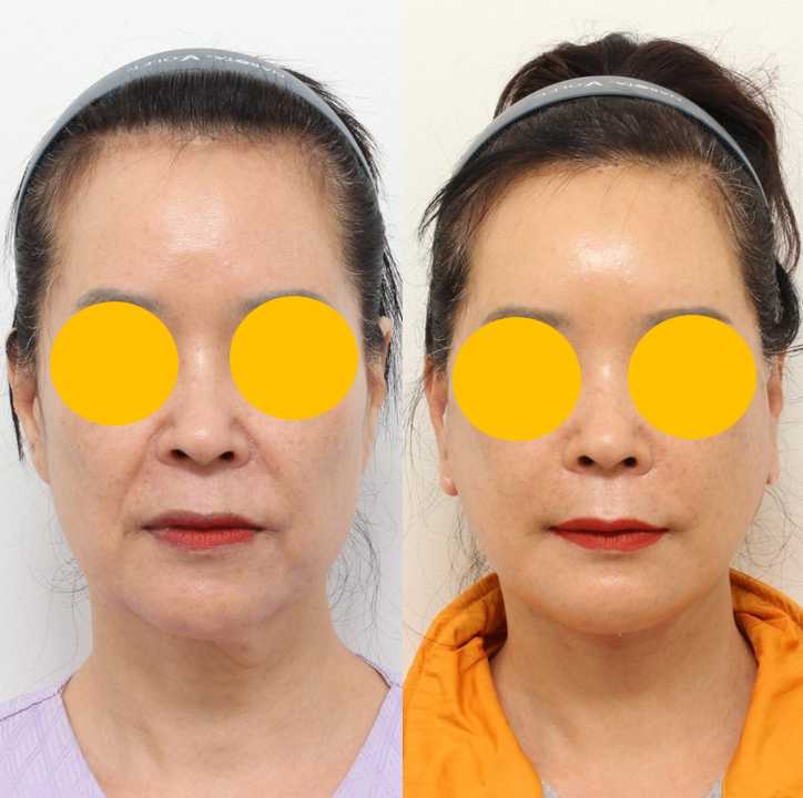 귀족수술을 했는데도 팔자주름이 남는 이유 관련 이미지 7