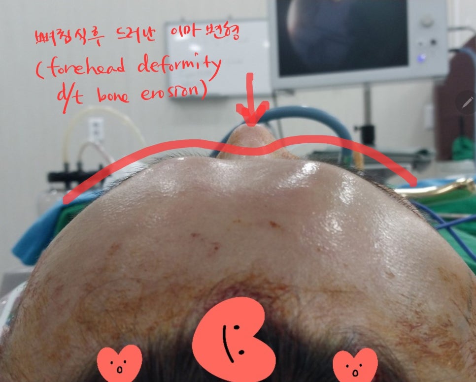 내시경을 이용한 최소절개 이마 보형물 제거 관련 이미지 9