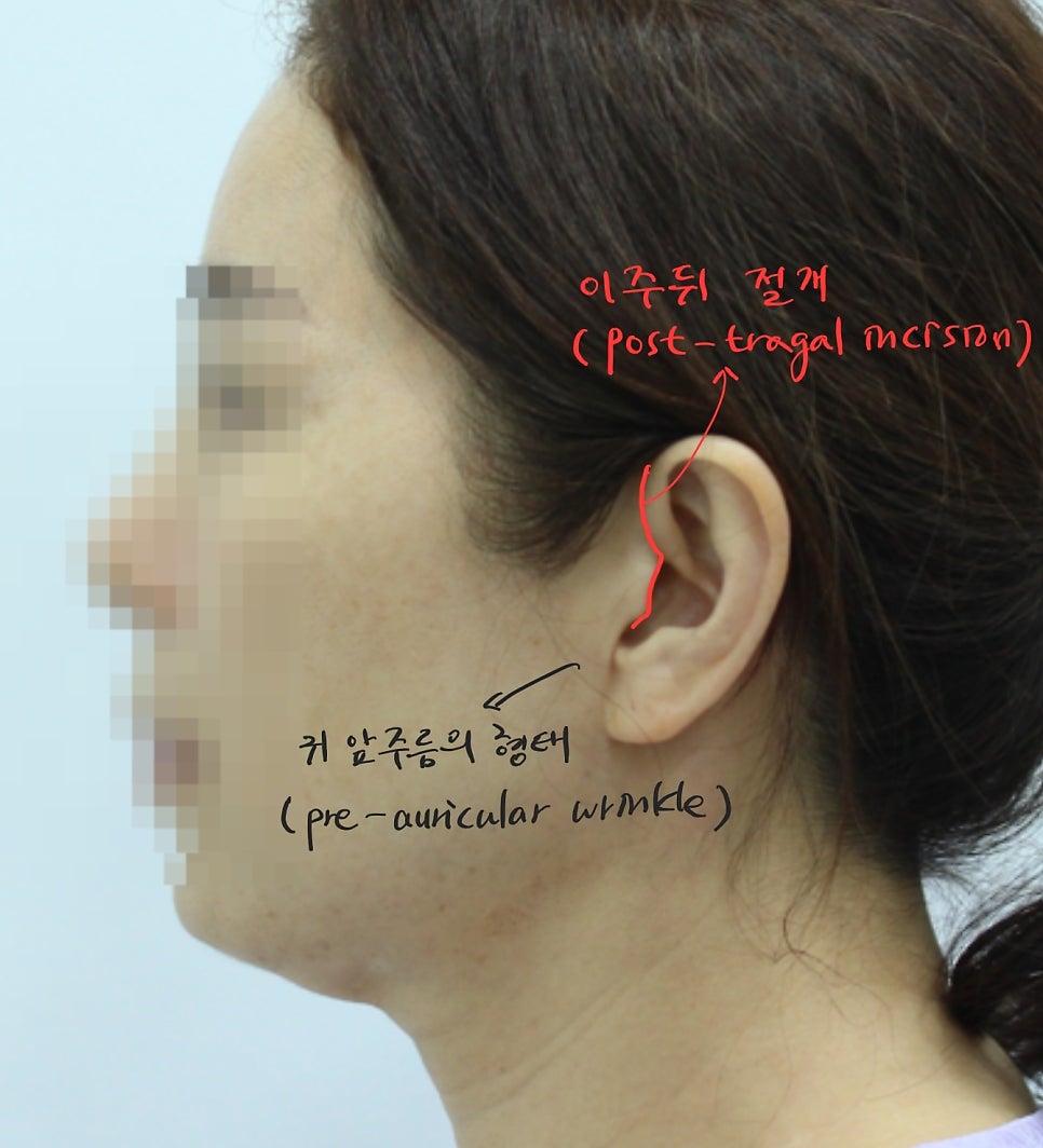 안면거상에서 절개선의 선택방법 관련 이미지 4
