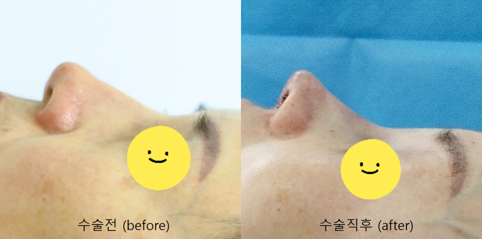 석회화된 실리콘 교체 후 얇아진 피부를 보강하는 코재수술 관련 이미지 6