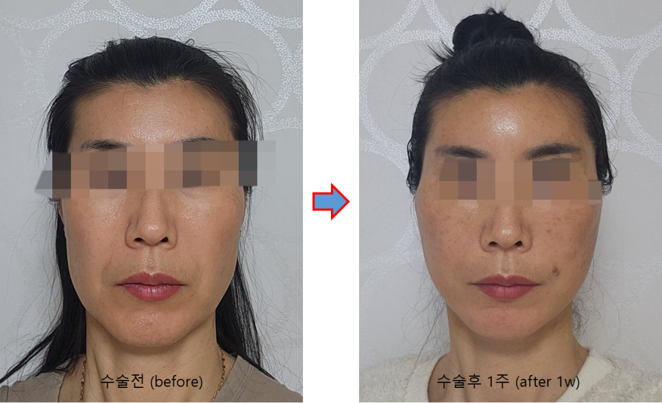 How a Facelift Changes Face Shape image 3