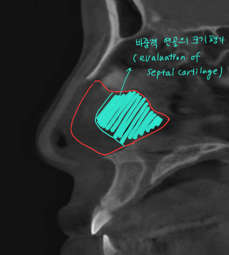 Information You Can Obtain Through CT Scanning During a Consultation for Revision Rhinoplasty image 6