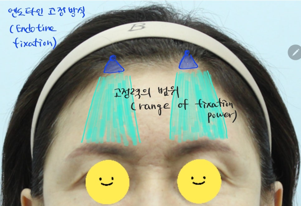 콧등주름과 미간주름의 리프팅 방법 관련 이미지 4