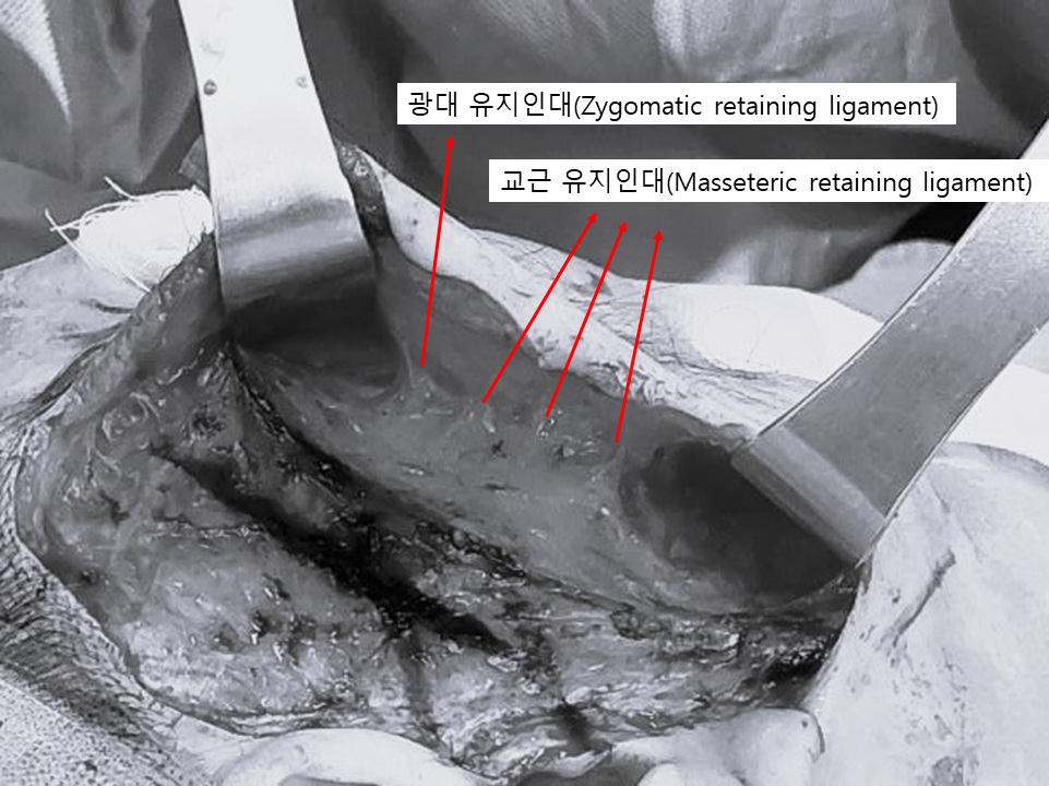앞볼 지방과 심부볼 지방을 리프팅하는 딥미니거상 관련 이미지 4