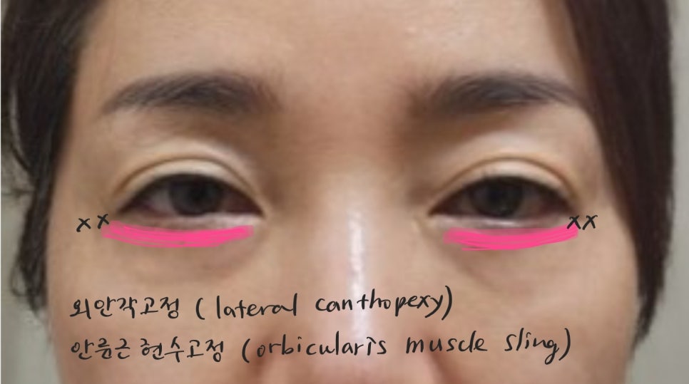 애교살을 보존하는 하안검 수술 관련 이미지 7