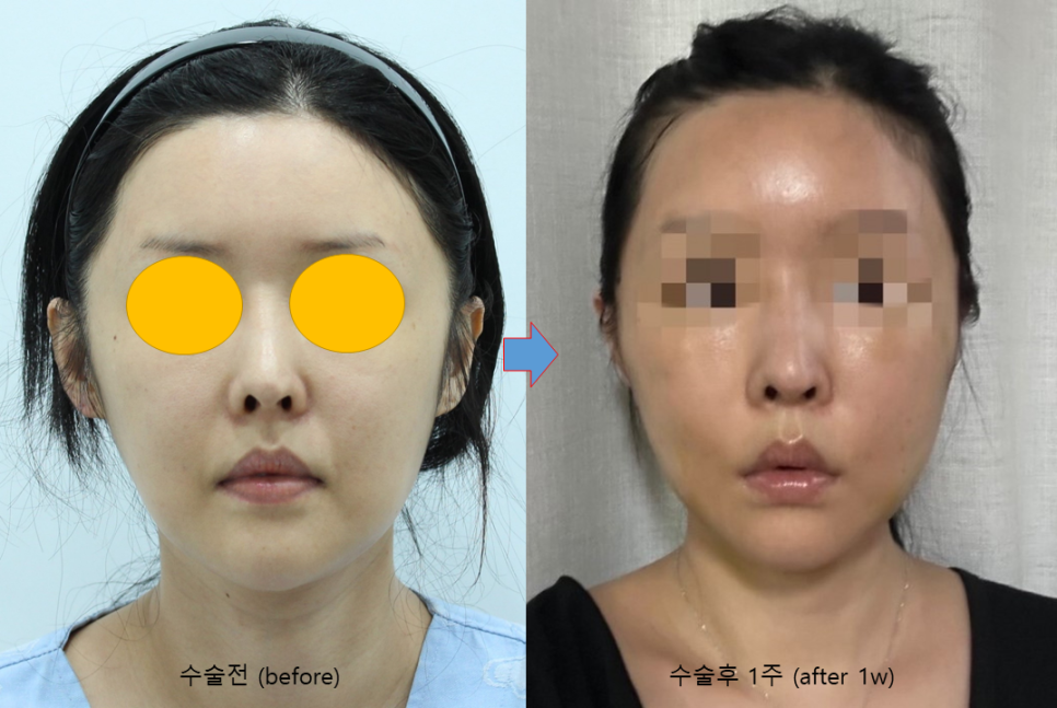 Natural Thread Lifting Using the Face’s Glide Planes image 5