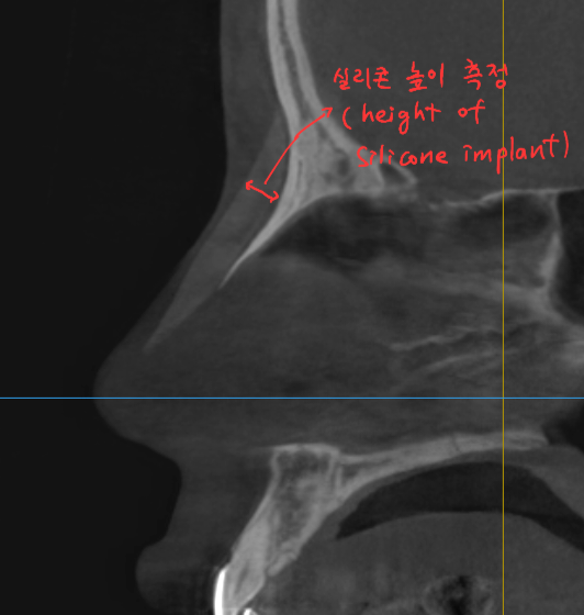 Information You Can Obtain Through CT Scanning During a Consultation for Revision Rhinoplasty image 1