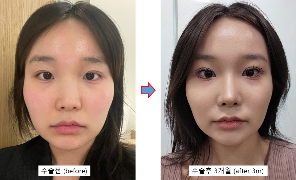 Will Rhinoplasty Cause Inflammation If You Have It in the Summer? Here’s a Real Recovery Case image 4