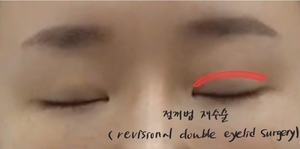 Double Eyelid Surgery and Ptosis Correction image 3