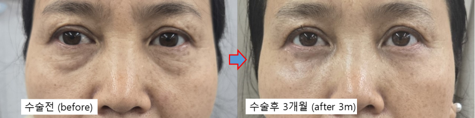 하안검 수술, 어디까지 변화하고 있을까? 관련 이미지 4