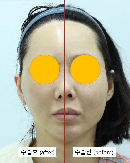 Cheek Sagging After Cheekbone Reduction Surgery? image 4