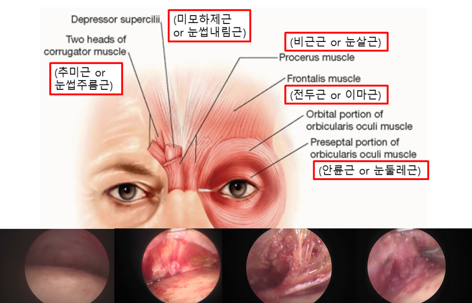 이마주름은 보톡스로 펴졌는데, 왜 눈은 더 무거워질까? 관련 이미지 3