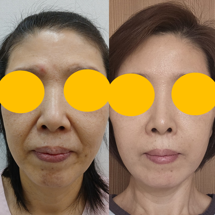 안면거상 후 흉터, 얼마나 남을까요? 흉터의 변화와 관리법 관련 이미지 6