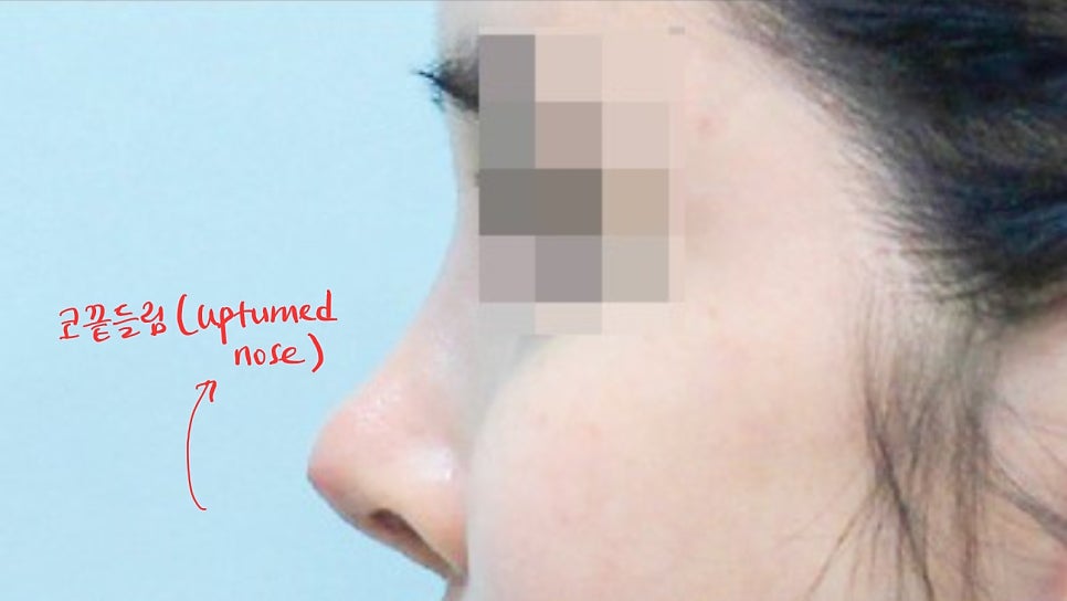Nasal Tip Skin Irritation Caused by L-Shaped Silicone image 2