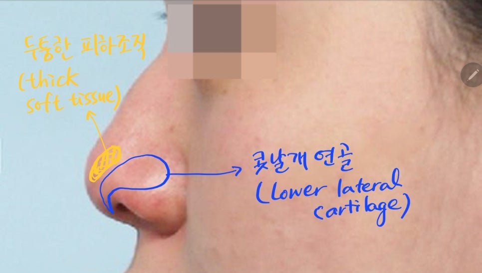 Various Nasal Tip Procedures for Bulbous Nose Correction image 2