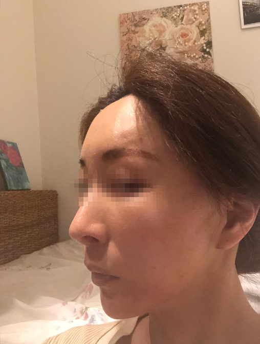 안면윤곽 수술 후 피부처짐의 치료 관련 이미지 7