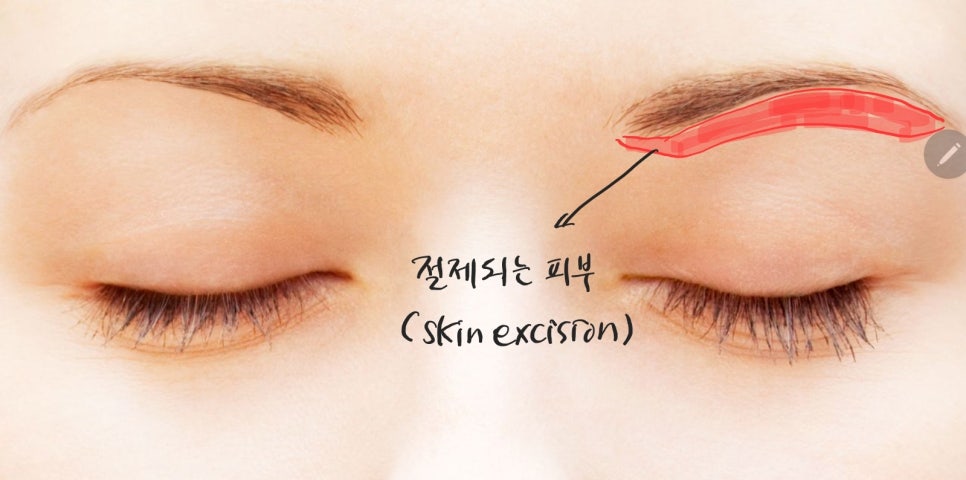 자연스럽고 부담이 적은 눈썹하거상 관련 이미지 2