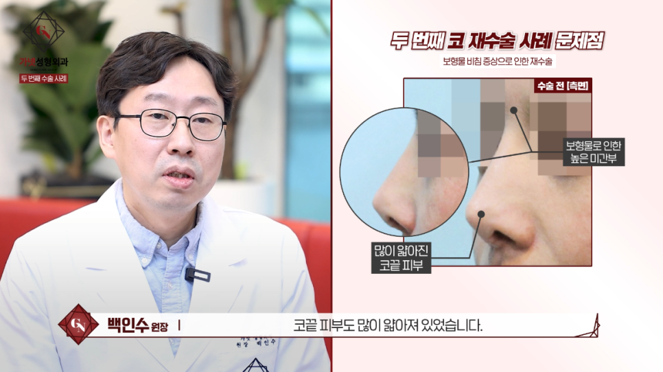 Why You Should Have Revision Rhinoplasty at a Place That Specializes in Apgujeong Nose Revision Surgery (ft. Dr. Baek In-soo) image 5