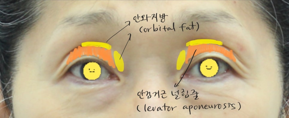 Upper Eyelid Surgery with Upper Eyelid Fat Repositioning image 4