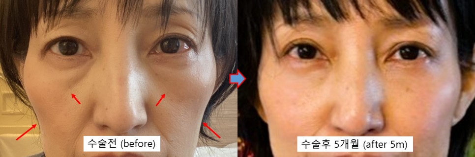 Facial Aging After Successful Weight Loss: Causes and Solutions for Ozempic Face image 4